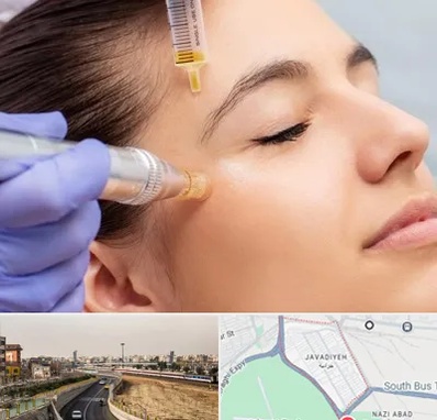 میکرونیدلینگ در جوادیه