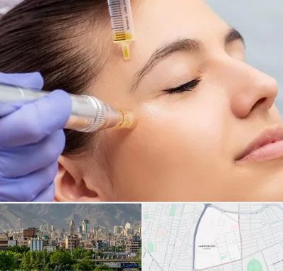 میکرونیدلینگ در جمشیدیه