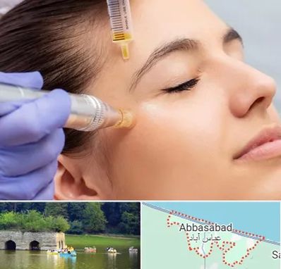 میکرونیدلینگ در عباس آباد