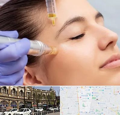 میکرونیدلینگ در منطقه 11 تهران