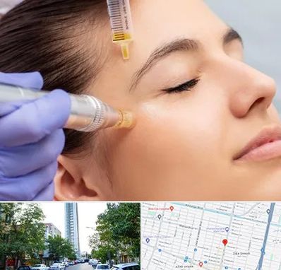 میکرونیدلینگ در امامت مشهد