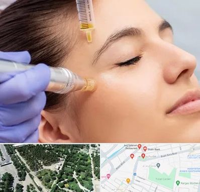 میکرونیدلینگ در سالاریه قم