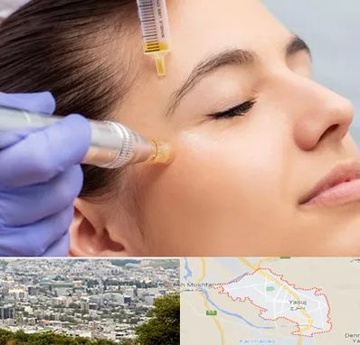 میکرونیدلینگ در یاسوج