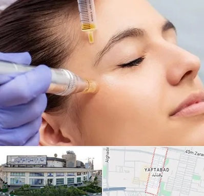 میکرونیدلینگ در یافت آباد