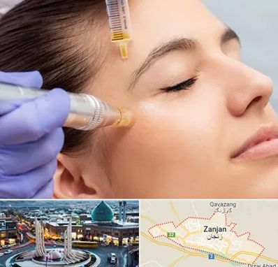 میکرونیدلینگ در زنجان