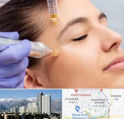 میکرونیدلینگ در شهرک غرب تهران