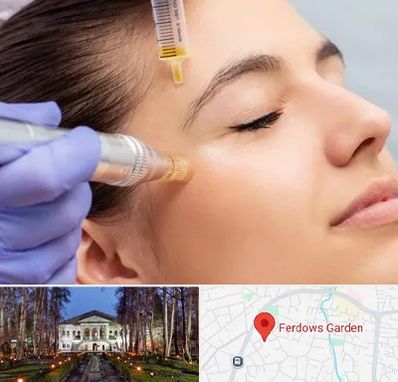 میکرونیدلینگ در باغ فردوس