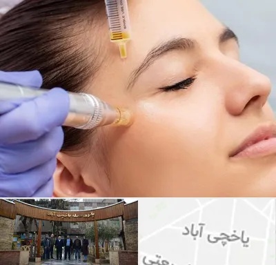 میکرونیدلینگ در یاخچی آباد