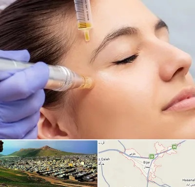 میکرونیدلینگ در بیجار