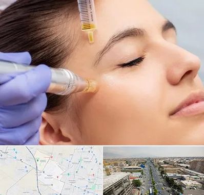 میکرونیدلینگ در حصارک کرج