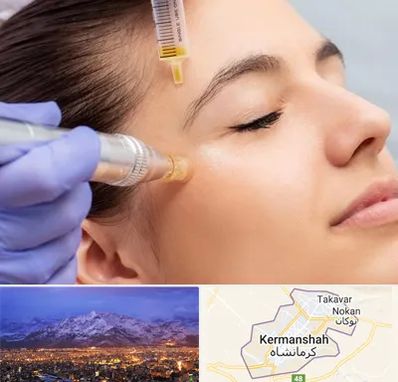 میکرونیدلینگ در کرمانشاه