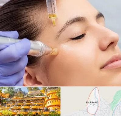 میکرونیدلینگ در دربند