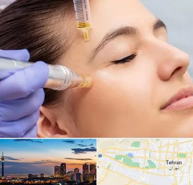 میکرونیدلینگ در غرب تهران تهران