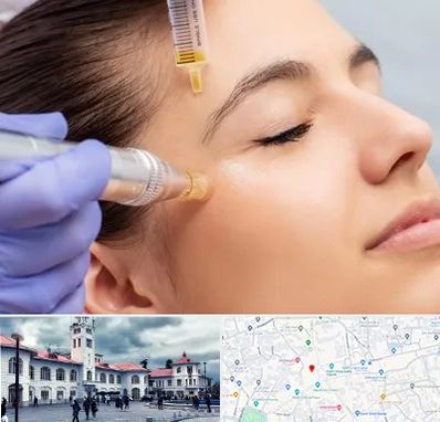 میکرونیدلینگ در میدان شهرداری رشت