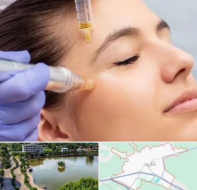 میکرونیدلینگ در لنگرود