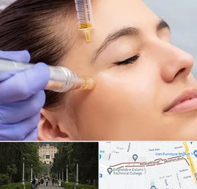 میکرونیدلینگ در بلوار معلم رشت