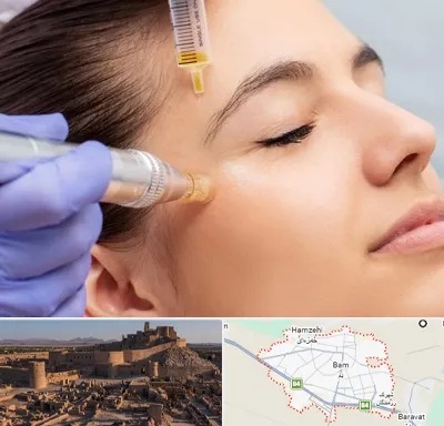 میکرونیدلینگ در بم