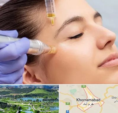 میکرونیدلینگ در خرم آباد