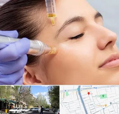 میکرونیدلینگ در کوی فیروز تبریز