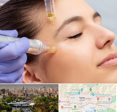 میکرونیدلینگ در منطقه 1 تهران