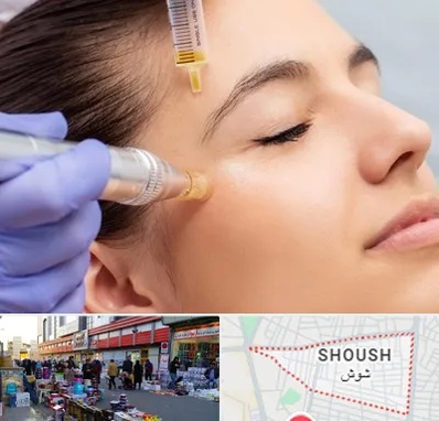 میکرونیدلینگ در شوش