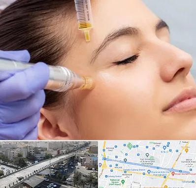 میکرونیدلینگ در فرجام