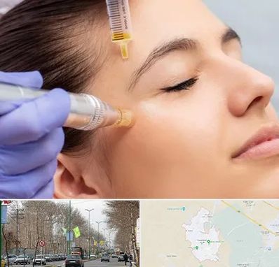 میکرونیدلینگ در نظرآباد کرج