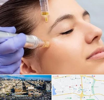 میکرونیدلینگ در شهرک راه آهن