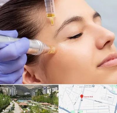 میکرونیدلینگ در بلوار تعاون