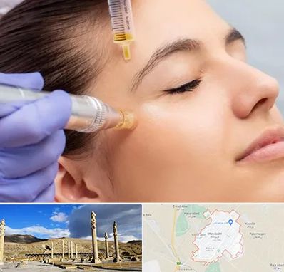 میکرونیدلینگ در مرودشت