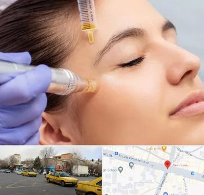 میکرونیدلینگ در شهناز تبریز