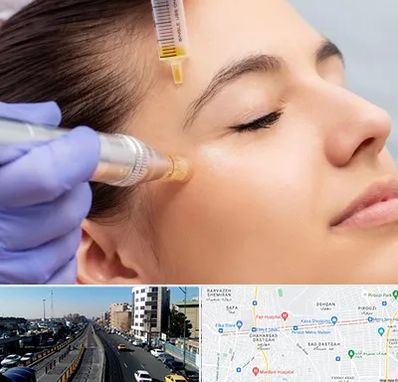 میکرونیدلینگ در پیروزی