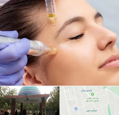 میکرونیدلینگ در کیانشهر