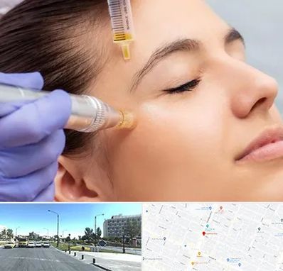 میکرونیدلینگ در بلوار کلاهدوز مشهد