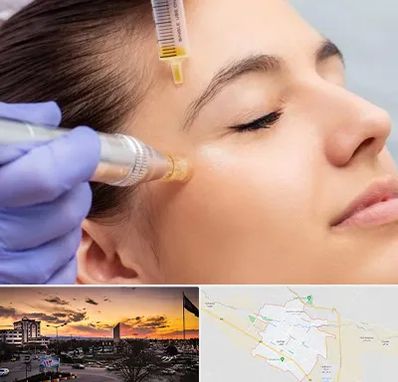 میکرونیدلینگ در قوچان