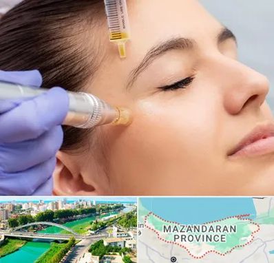 میکرونیدلینگ در مازندران