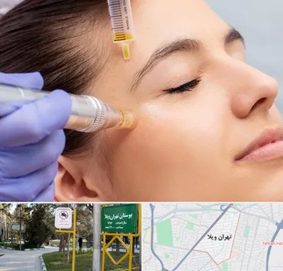میکرونیدلینگ در تهران ویلا