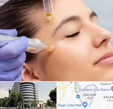 میکرونیدلینگ در قلهک