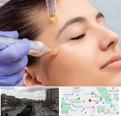 میکرونیدلینگ در بلوار فردوسی مشهد