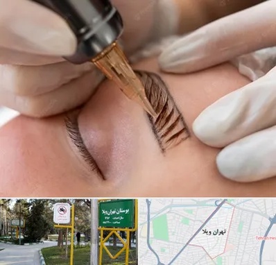 میکروبلیدینگ در تهران ویلا