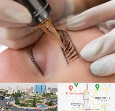 میکروبلیدینگ در ونک تهران