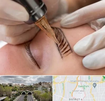 میکروبلیدینگ در یوسف آباد