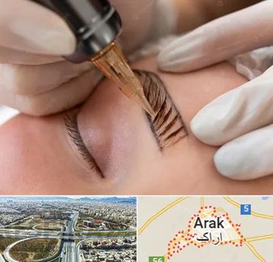 میکروبلیدینگ در اراک