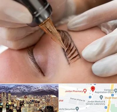 میکروبلیدینگ در جردن