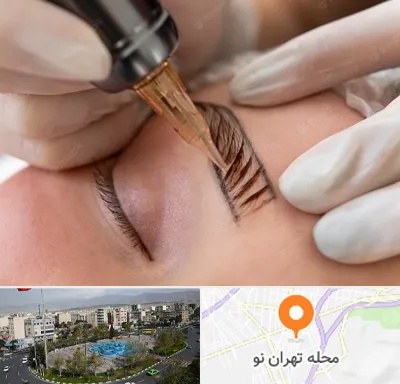 میکروبلیدینگ در تهران نو