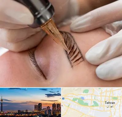 میکروبلیدینگ در غرب تهران تهران