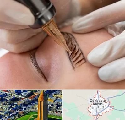 میکروبلیدینگ در گنبد کاووس