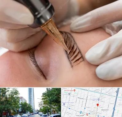 میکروبلیدینگ در امامت مشهد