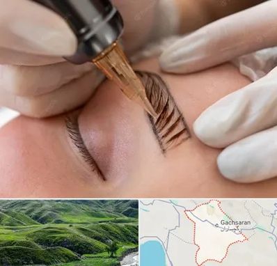 میکروبلیدینگ در گچساران