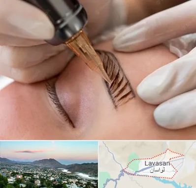 میکروبلیدینگ در لواسان